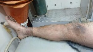 Choque elétrico deixa trabalhador com queimaduras de 3º grau em fazenda de MT